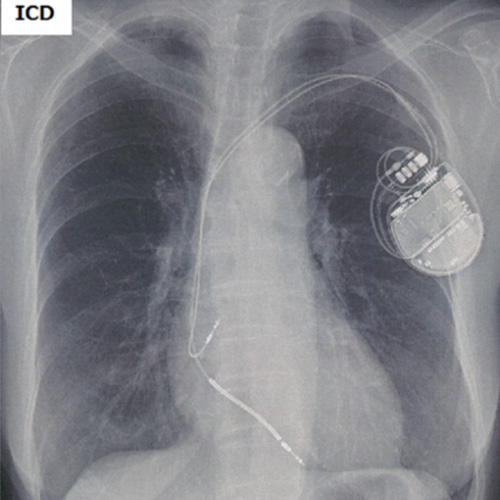 ペースメーカー、植え込み型除細動器 u2013 東海大学 循環器内科