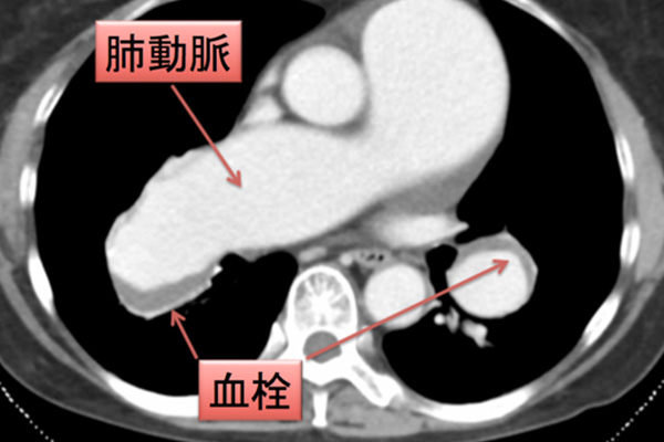 動脈塞栓症はどうすれば予防できるのでしょうか?
